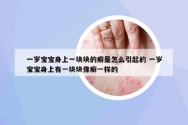 一岁宝宝身上一块块的癣是怎么引起的 一岁宝宝身上有一块块像癣一样的