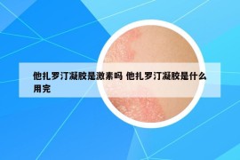 他扎罗汀凝胶是激素吗 他扎罗汀凝胶是什么用完