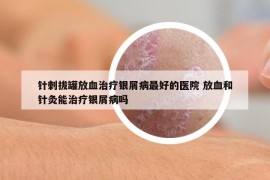 针刺拔罐放血治疗银屑病最好的医院 放血和针灸能治疗银屑病吗