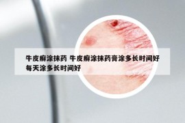 牛皮癣涂抹药 牛皮癣涂抹药膏涂多长时间好每天涂多长时间好