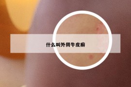 什么叫外阴牛皮癣
