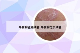 牛皮癣正确读音 牛皮癣怎么读音