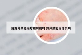 鲜野芹菜能治疗银屑病吗 野芹菜能治什么病