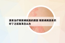 激素治疗银屑病反跳的原因 银屑病用激素药好了之后复发怎么办