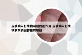 皮肤病人打生物制剂的副作用 皮肤病人打生物制剂的副作用有哪些