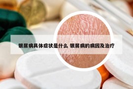 银屑病具体症状是什么 银屑病的病因及治疗