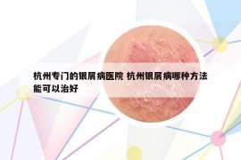 杭州专门的银屑病医院 杭州银屑病哪种方法能可以治好