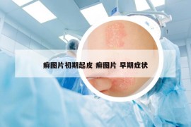 癣图片初期起皮 癣图片 早期症状