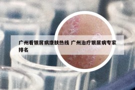 广州看银屑病康肤热线 广州治疗银屑病专家排名