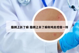 胳膊上长了癣 胳膊上长了癣和鸡皮疙瘩一样
