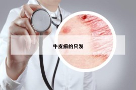 牛皮癣的只发