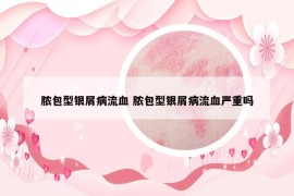 脓包型银屑病流血 脓包型银屑病流血严重吗