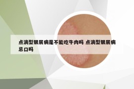 点滴型银屑病是不能吃牛肉吗 点滴型银屑病忌口吗