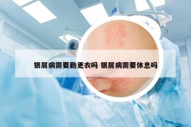 银屑病需要勤更衣吗 银屑病需要休息吗