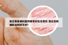 宿迁银屑病科医院哪家好优先楚街 宿迁皮肤病防治所好不好?