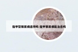 指甲型银屑病遗传吗 指甲银屑病能治愈吗