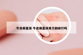 牛皮癣直接 牛皮癣直接用刀割掉行吗