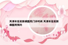 天津长征皮肤病医院门诊时间 天津长征皮肤病医院预约