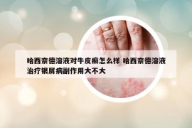 哈西奈德溶液对牛皮癣怎么样 哈西奈德溶液治疗银屑病副作用大不大
