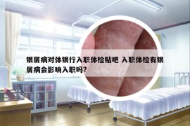 银屑病对体银行入职体检贴吧 入职体检有银屑病会影响入职吗?