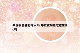 牛皮癣患者能吃vc吗 牛皮肤癣能吃维生素c吗