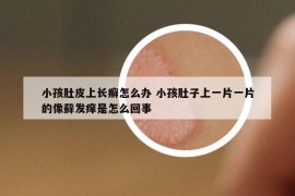 小孩肚皮上长癣怎么办 小孩肚子上一片一片的像藓发痒是怎么回事