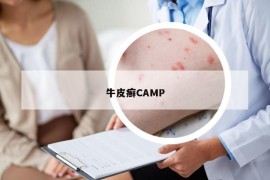 牛皮癣CAMP