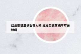 红皮型银屑病会死人吗 红皮型银屑病不可逆转吗