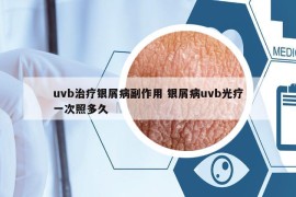 uvb治疗银屑病副作用 银屑病uvb光疗一次照多久