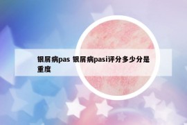 银屑病pas 银屑病pasi评分多少分是重度