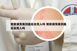 银屑病发展到最后会死人吗 银屑病发展到最后会死人吗