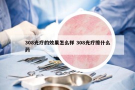 308光疗的效果怎么样 308光疗擦什么药