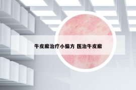 牛皮廨治疗小偏方 医治牛皮廨