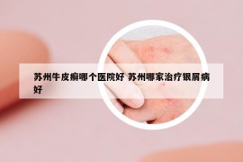 苏州牛皮癣哪个医院好 苏州哪家治疗银屑病好