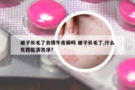 被子长毛了会得牛皮癣吗 被子长毛了,什么东西能清洗净?