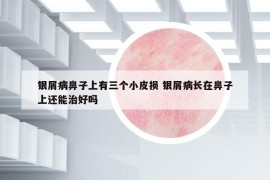 银屑病鼻子上有三个小皮损 银屑病长在鼻子上还能治好吗