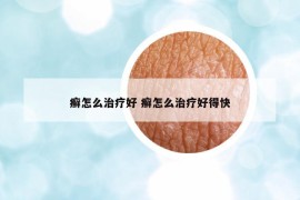癣怎么治疗好 癣怎么治疗好得快
