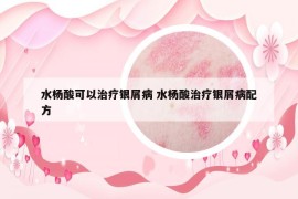 水杨酸可以治疗银屑病 水杨酸治疗银屑病配方