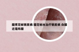 醋煮花椒银屑病 醋花椒水治疗银屑病 白醋还是陈醋