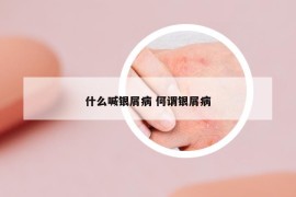 什么喊银屑病 何谓银屑病
