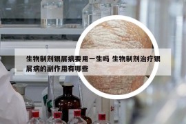 生物制剂银屑病要用一生吗 生物制剂治疗银屑病的副作用有哪些