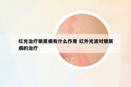 红光治疗银屑病有什么作用 红外光波对银屑病的治疗