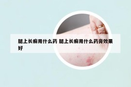 腿上长癣用什么药 腿上长癣用什么药膏效果好