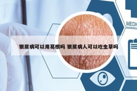 银屑病可以用葛根吗 银屑病人可以吃虫草吗