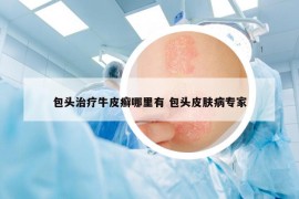 包头治疗牛皮癣哪里有 包头皮肤病专家
