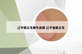 辽宁新立屯看牛皮癣 辽宁省新立屯