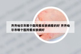 齐齐哈尔市那个医院看皮肤病看的好 齐齐哈尔市哪个医院看皮肤病好