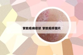 掌脓疱病症状 掌脓疱疹图片