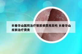 长春华山医院治疗银屑病费用高吗 长春华山皮肤治疗费贵