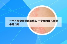 一个月宝宝会得银屑病么 一个月的婴儿会得手足口吗